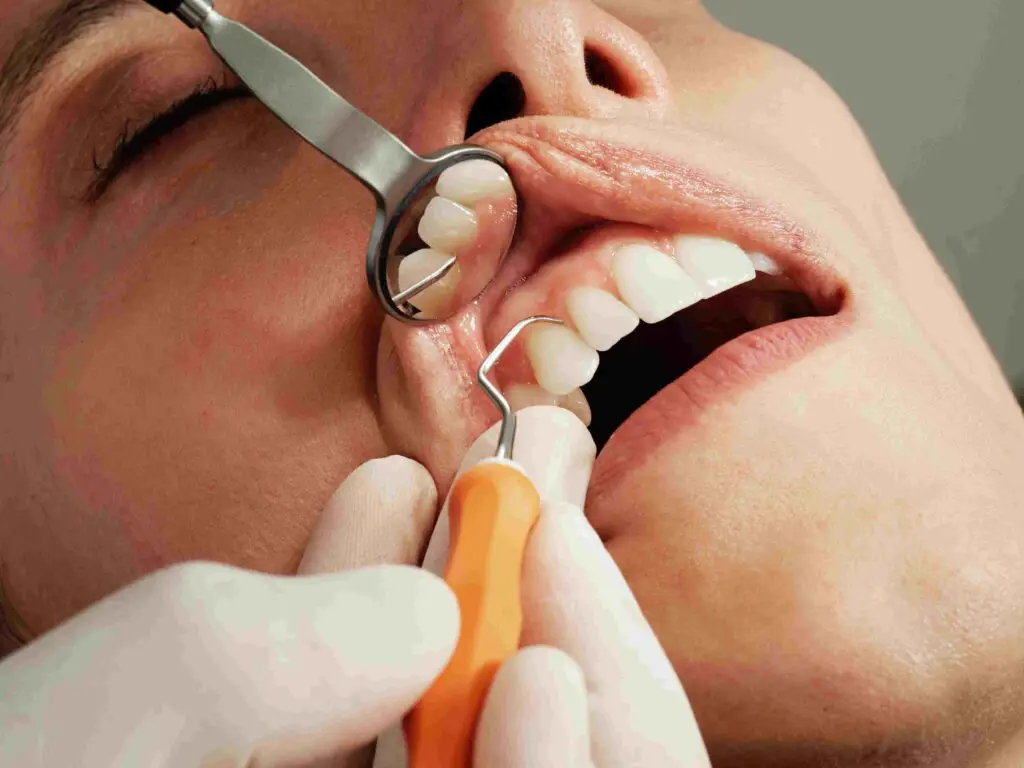 remove Tartar and Plaque from Teeth