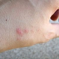 things to put on your body to prevent bed bug bites